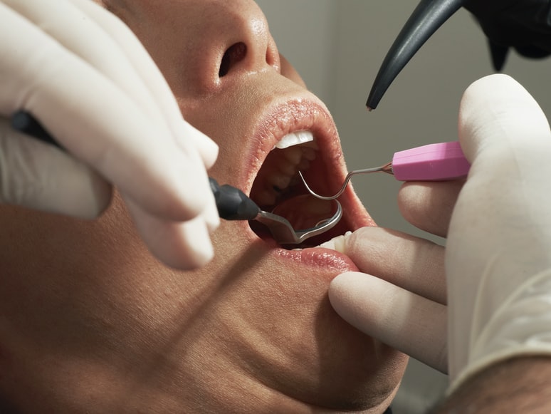 Image of a dental procedure in dental practices for sale in Canada